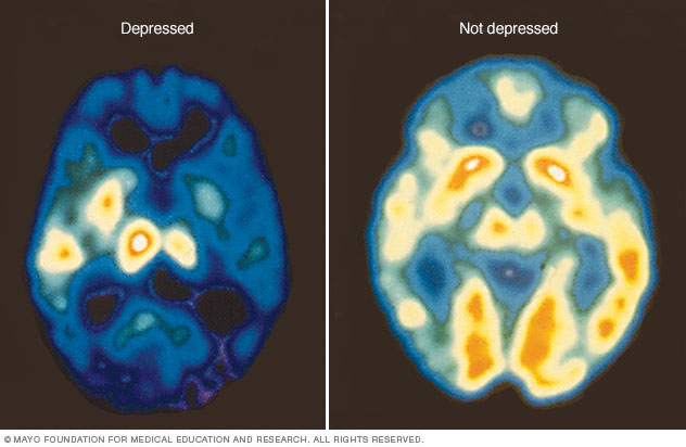 Depressed PET Scan
